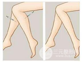 瘦小腿吸脂多少钱