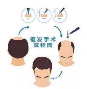 发际线植发多少钱 科普篇~ 发际线植发多少钱 科普篇~