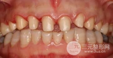 牙齿烤瓷贴面多少钱一颗