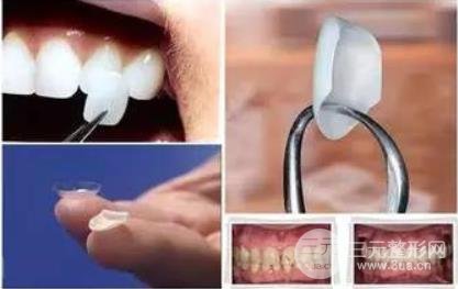 牙齿烤瓷贴面多少钱