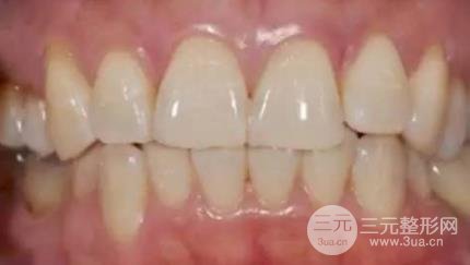 全瓷牙贴面