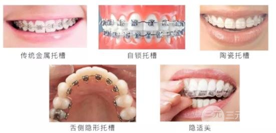 北京三甲牙齿矫正价格