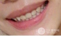 上海九院整牙价格表2020+深覆合求美者的矫正案例~