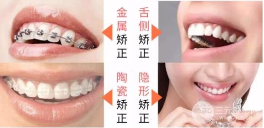 镇江牙齿矫正价目表