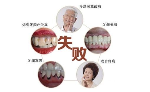 烤瓷牙的材料和价格