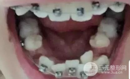 门牙龅牙矫正