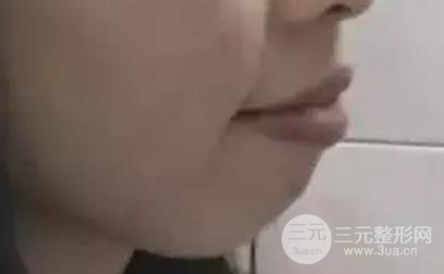 龅牙正颌手术