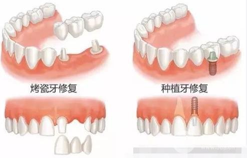 上海烤瓷牙价格表2019