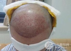 植3000根头发多少钱?能保持一辈子吗? 植3000根头发多少钱?能保持一辈子吗?