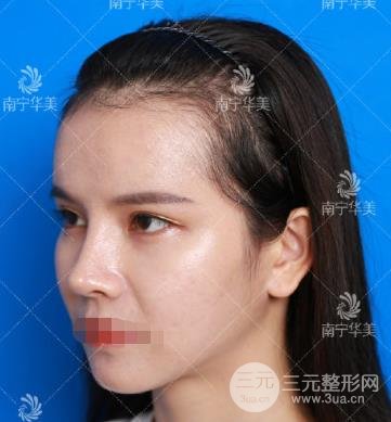 南宁华美植发案例