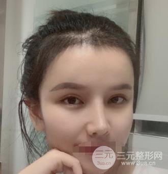 南宁华美植发案例