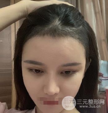 南宁华美发际线调整