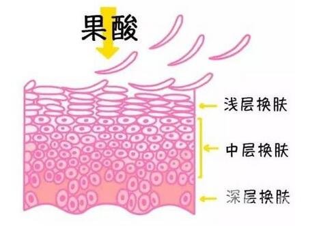 果酸换肤一次有用吗