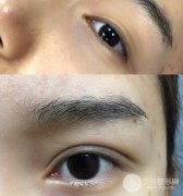 日式微创双眼皮价格一般是多少钱