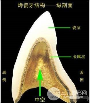 烤瓷牙结构