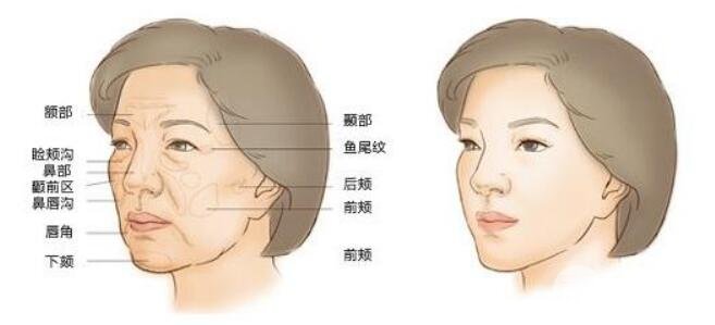 脂肪填充额头太阳穴