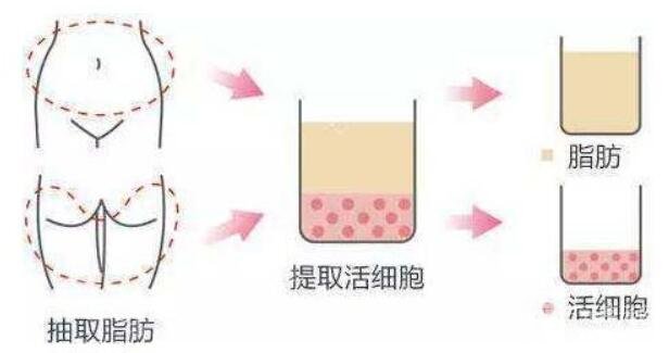 脂肪填充术过程示意图