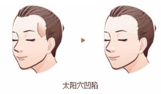自体脂肪丰太阳穴前后果展示