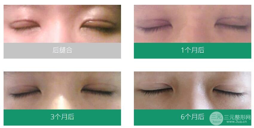 双眼皮术后恢复情况展示