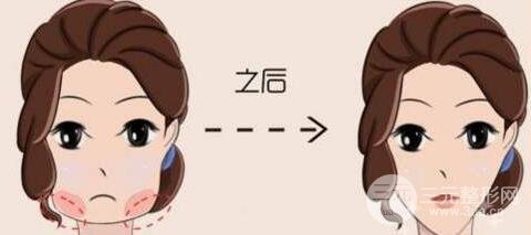 注射瘦脸副作用