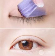 成都割双眼皮价钱贵不贵 注意事项详解
