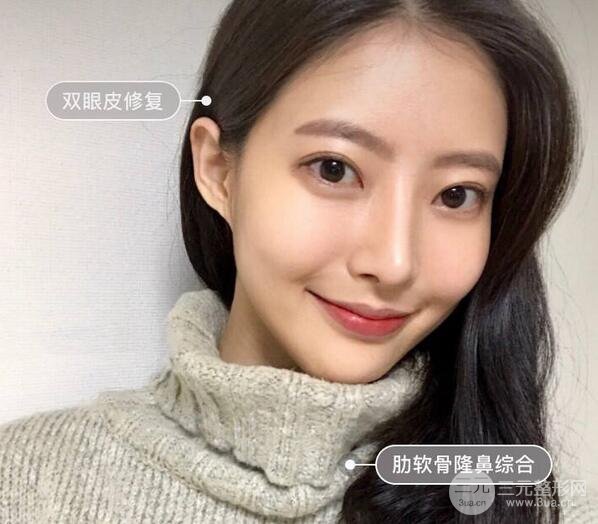 隆鼻修复