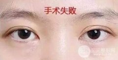 双眼皮失败了怎么办 这些原因和解决方法要知晓
