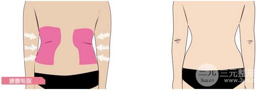 腹部吸脂手术价格
