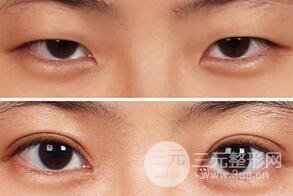 三点式双眼皮