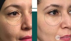 成都有黑眼圈怎么消除 常熬夜的必须看