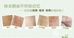 激光整形美容能去疤痕吗 祛疤费用是多少