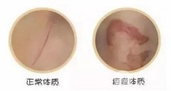 常说的疤痕体质能做整形美容吗