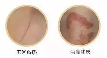 疤痕体质