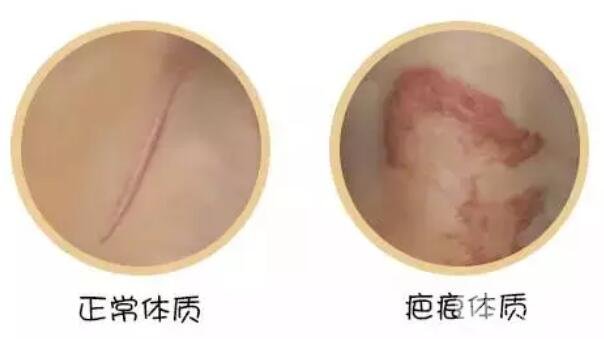 疤痕体质有什么特征