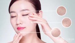 点阵激光祛痘一般要做几次好勒 【激光护肤项目】