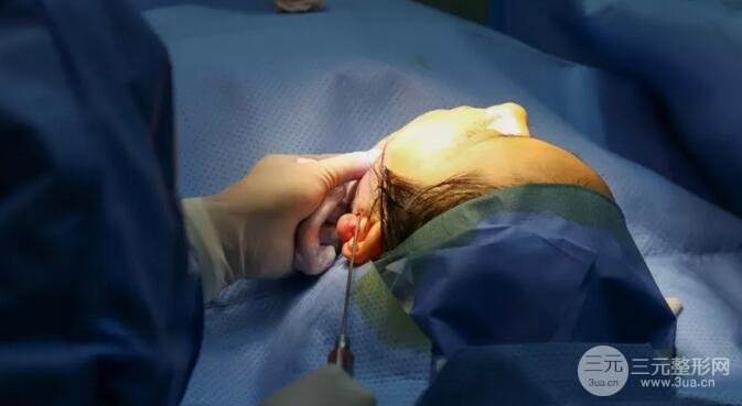 怎么才能减双下巴