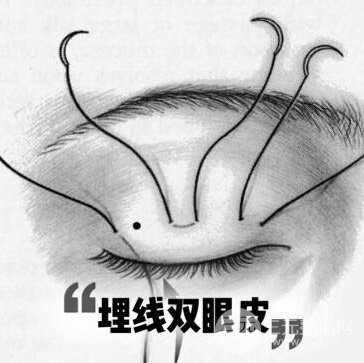埋线双眼皮