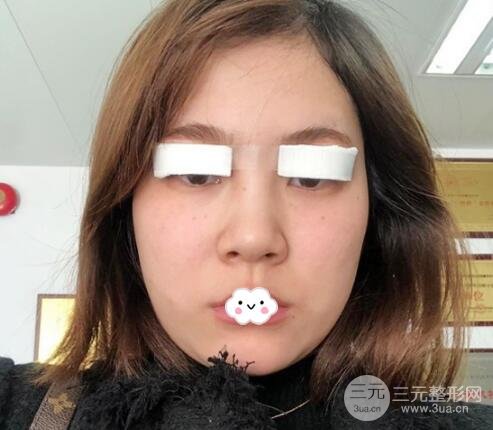 埋线双眼皮案例