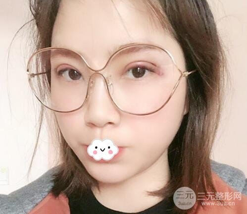 埋线双眼皮果好不好