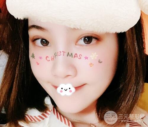 埋线双眼皮术后多久恢复