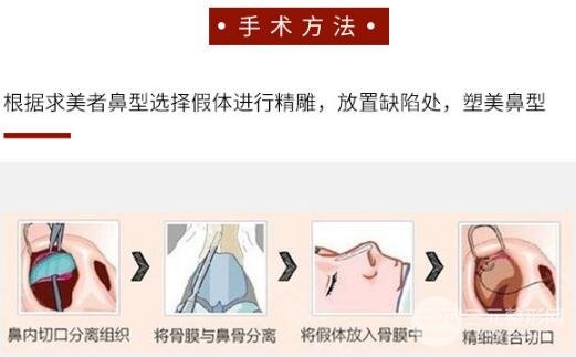 硅胶隆鼻要多少钱 手术怎么做