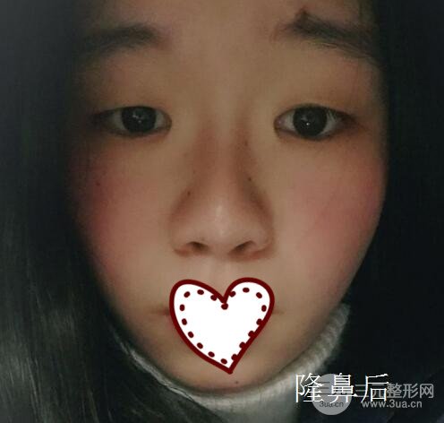 硅胶隆鼻要多少钱