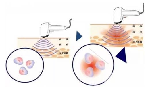 谁做过彩光嫩肤有果吗