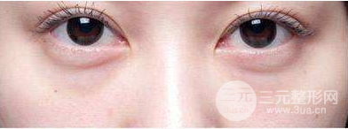 眼袋抽脂术的原理及果 眼袋抽脂术的原理及果