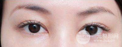 眼袋抽脂术的原理及果 眼袋抽脂术的原理及果