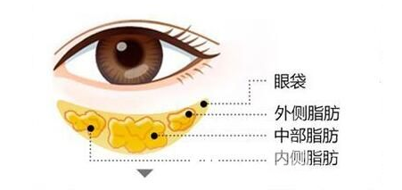 眼袋抽脂术的原理及果 眼袋抽脂术的原理及果