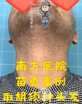 植发发量不足怎么办 植发发量不足怎么办