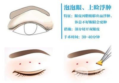 肿眼泡吸脂手术价格贵不贵 手术原理