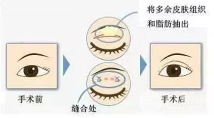 肿眼泡吸脂价格揭秘|摆脱金鱼眼很简单！