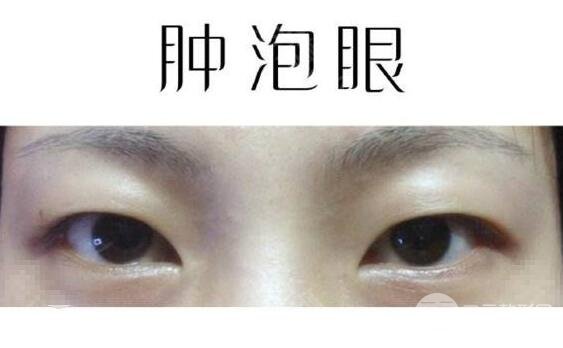 肿眼泡吸脂价格贵不贵